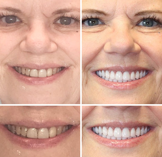 Amtnclub | HZA™ – Prothèse dentaire complète sur mesure pour un sourire naturel