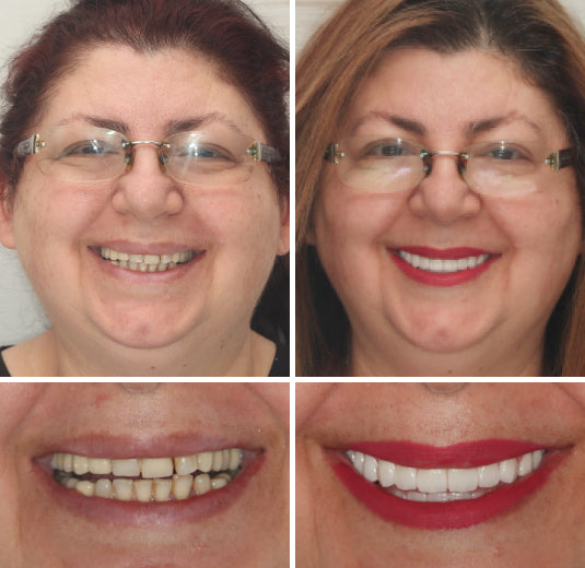 Amtnclub | HZA™ – Prothèse dentaire complète sur mesure pour un sourire naturel