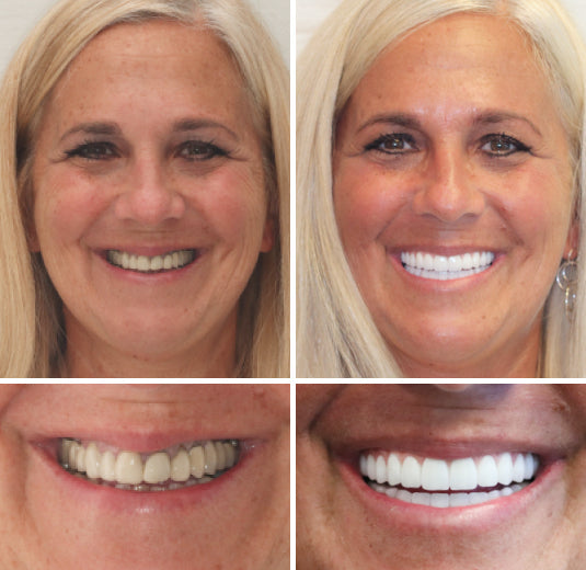 Amtnclub | HZA™ – Prothèse dentaire complète sur mesure pour un sourire naturel