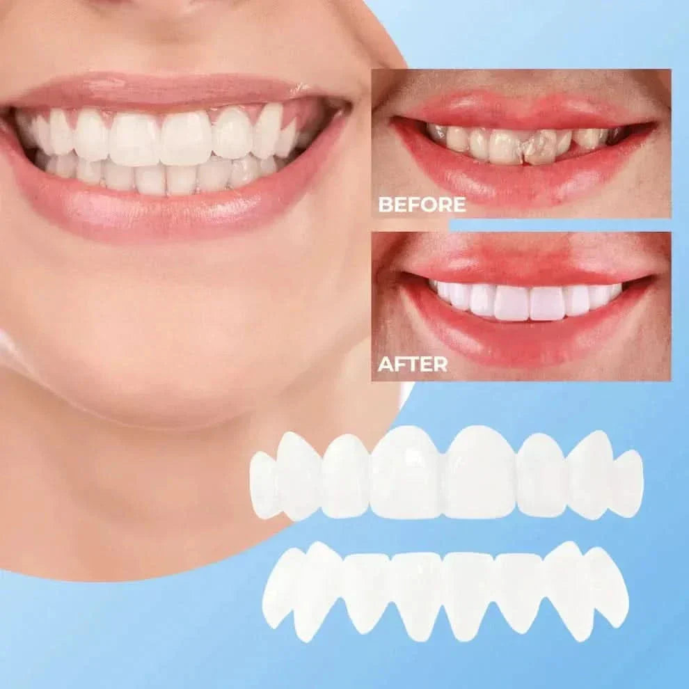 Facettes Dentaires Effet Blanc Naturel – Amtn Club
