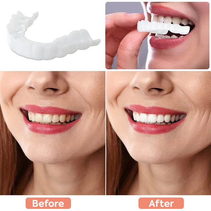 Facettes Dentaires Effet Blanc Naturel – Amtn Club
